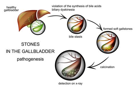 The Pathogenesis Of Gallstones Total Ayurveda