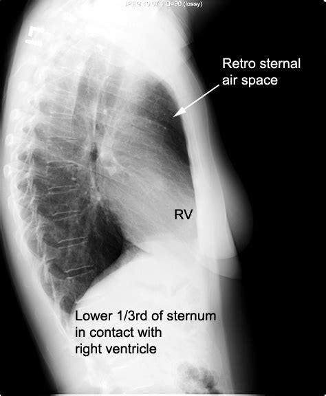 Identify The Retrosternal Air Space What Is Normal Retrosternal Space