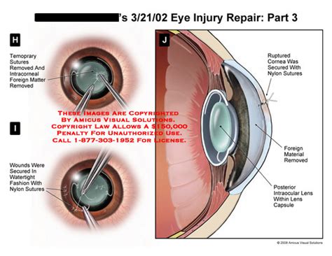 Amicus Illustration Of Amicussurgeryeyerepairlensintraocularcapsuleremovedplaced