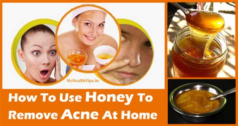 honey for acne use honey to remove acne and scars fast