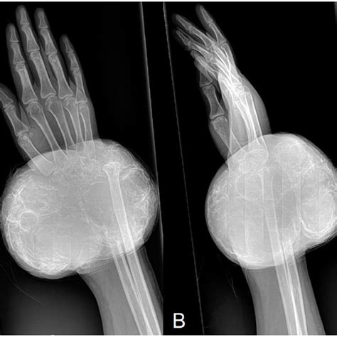 A B Initial Anteroposterior A And Lateral B Radiographs