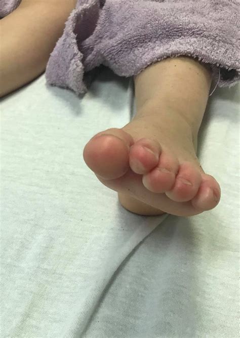 Girl 3 Left With Blisters And Burns On Her Feet After Walking On