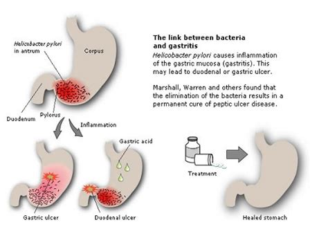 Treatment depends on the cause, but may include information about a therapy, service, product or treatment does not in any way endorse or support such therapy. Gastritis - causes, symptoms and treatment | Health Care ...
