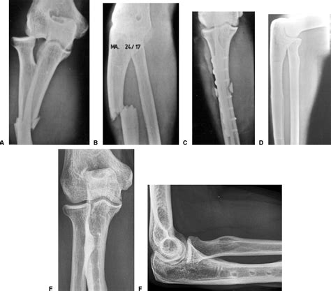Long Term Evaluation Of Surgically Treated Anterior Monteggia Fractures