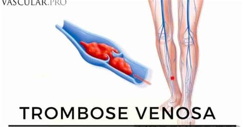 Entenda O Tev Tromboembolismo Venoso E Suas Consequ Ncias Graves