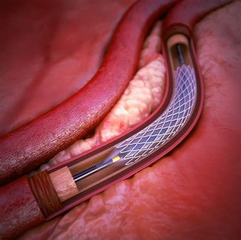 Pci Stents And Ballooning Of Coronary Arteries Free Consultation