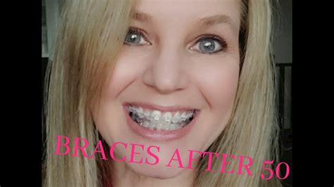 Why I Got Braces After 50 Youtube