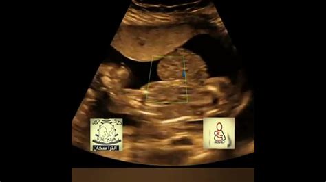 Pentalogy Of Cantrellectopia Cordis Fetal Ultrasound By Drhaissam