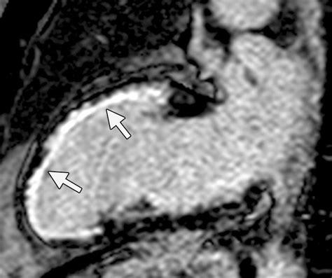 Mr Imaging Of Myocardial Infarction Radiographics