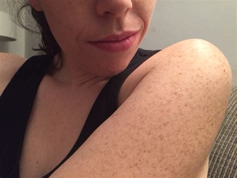 I Have Red Bumps On My Upper Arms Help Hannah Sowd Skin Care