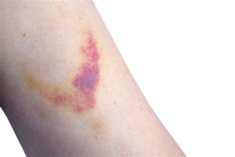 Hemorrhage Bruise Human Arm Physical Injury Stock Photos Pictures