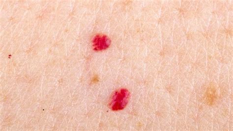 Cherry Angioma Removal At Home Causes Symptoms And Treatments