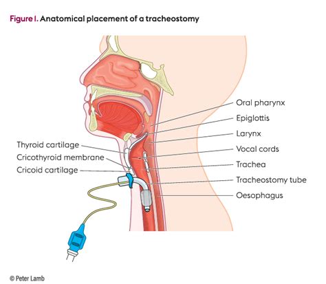 Tracheostomy Tube Insertion