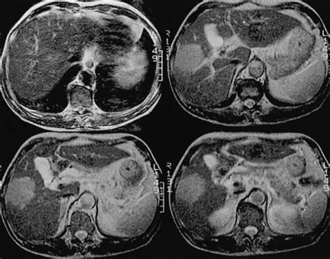 Liver Segments Mri