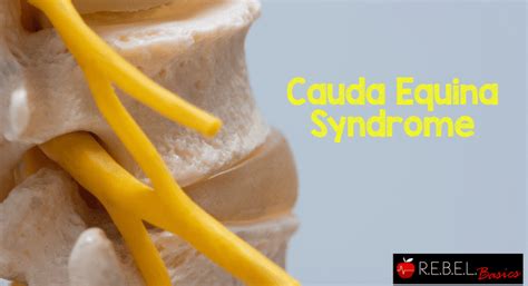 Disc herniation in the l5 to s1 area can occur when excessive loads are placed on your vertebrae. Cauda Equina Syndrome - R.E.B.E.L. EM - Emergency Medicine ...