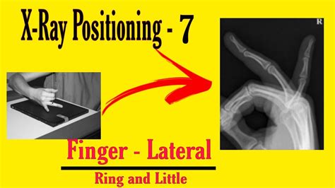 Finger Lateral X Ray Ring And Little X Ray Hindi X Ray Positioning