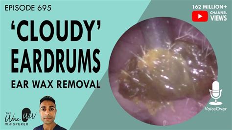 695 Cloudy Eardrums Ear Wax Removal Youtube