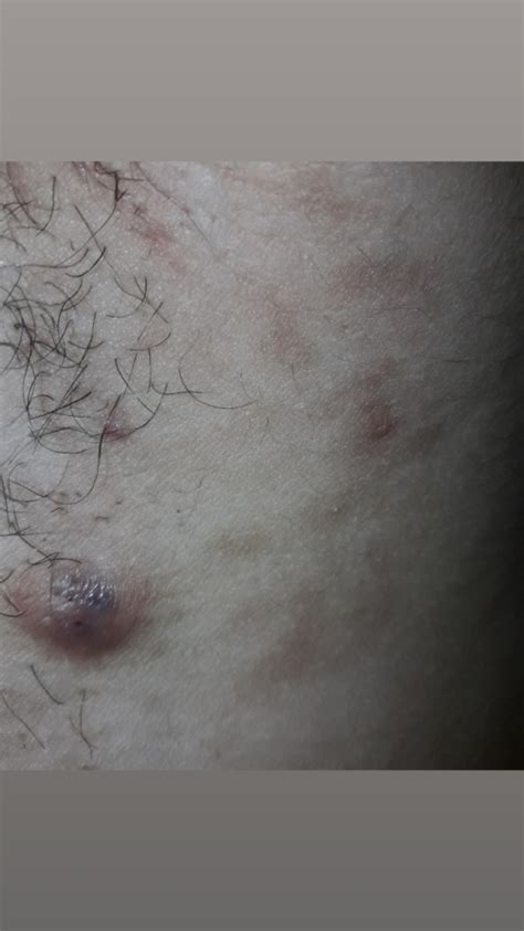 Ingrown hair armpit lump treatment. Lump !! Help please | Cancer | Forums | Patient