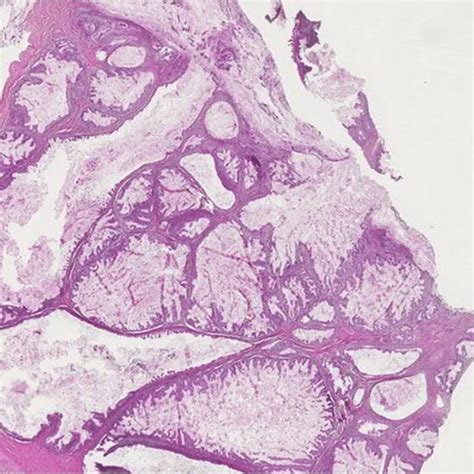 Mucinous Ovarian Carcinoma With An Expansile Pattern Complex Malignant