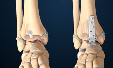Ankle Fusion Singapore Sports And Orthopedic Clinic