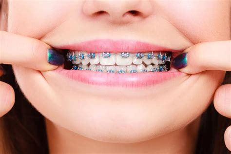 Loose Broken Or Poking Orthodontic Appliance Heres How To Fix It Weber Orthodontics