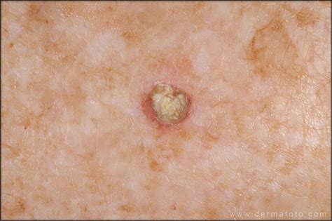 Pin On Skin Cancer