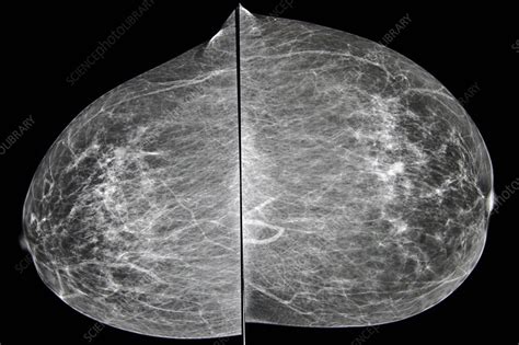 Breast Tumor X Ray Stock Image C0152217 Science Photo Library