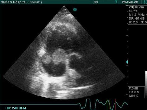Britannica, the editors of encyclopaedia. Two large thromboses in right atrium in four chamber view ...