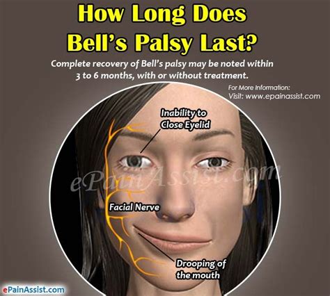 Bell S Palsy Treatment Most People Make A Full Recovery Within
