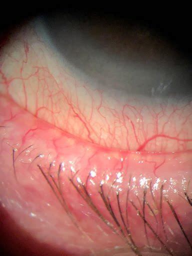 The Ultimate Guide To Demodex Blepharitis Eyes On Eyecare