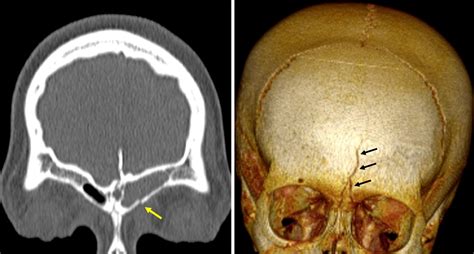 Linear Skull Fracture Radiology Cases