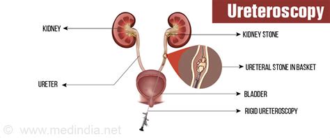 Kidney stones (also called renal calculi, nephrolithiasis or urolithiasis) are hard deposits made of minerals and salts that form inside your kidneys. Ureteroscopy - Overview