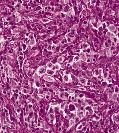 Pathology Outlines Lymphocyte Depleted Classic Hodgkin Lymphoma