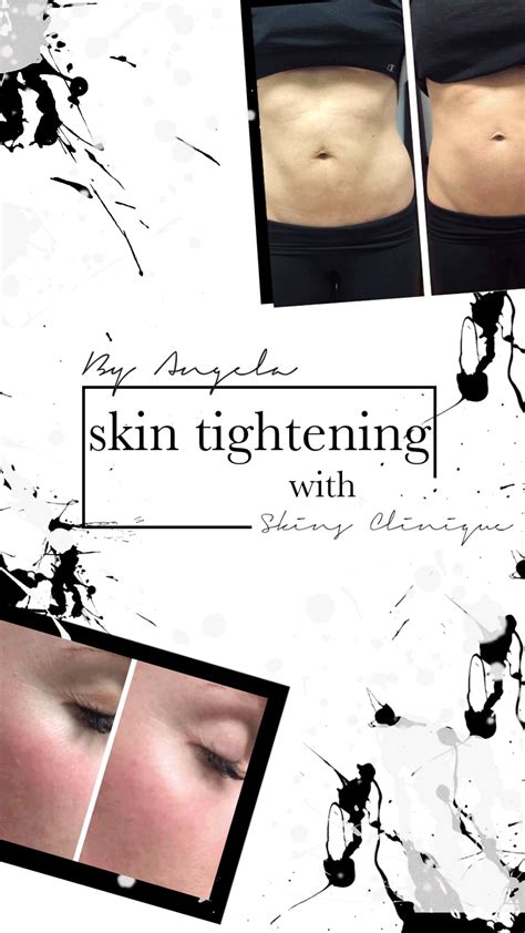 Skin Tightening With Skins Clinique — By Angela