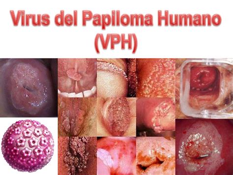 El Papiloma Humano Hot Sex Picture