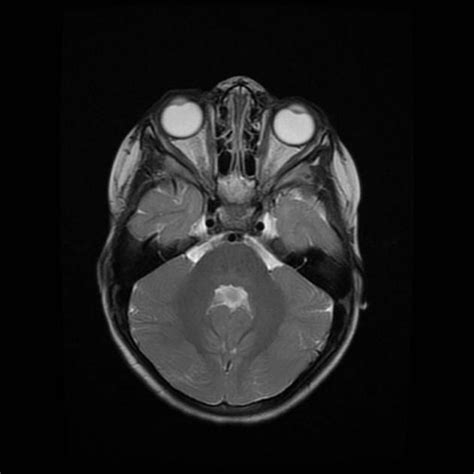 Joubert Syndrome Radiology Case Radiology