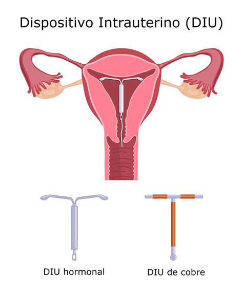 Dispositivo intrauterino DIU tipos eficácia formas de inserção