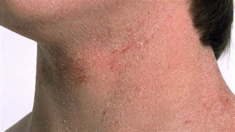 Autoimmune Disorders As Related To Dermatitis Pictures