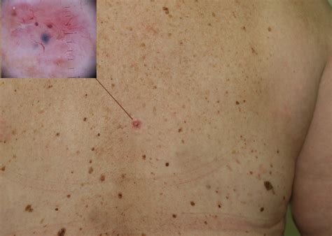 Skin Cancer Pictures Moles Symptoms Signs On Face Spots On Nose Photos