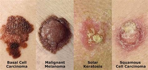 Examples Of Skin Cancer Spots
