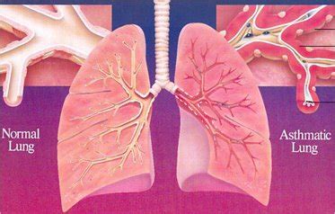 Huang yj, nelson ce, brodie el, desantis tz, baek. Management Bronchial Asthma | Procedure, Treatment and Therapy
