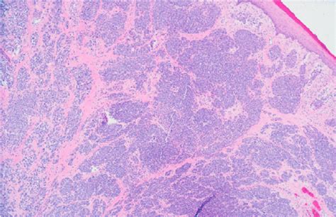 Hematoxylin And Eosinstained Pathology Slide Of The Nodular Melanoma