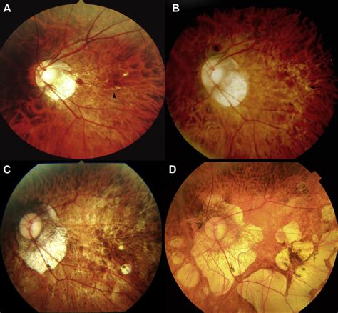 Representative Fundus Photographs From A 31 Year Old Woman Showing