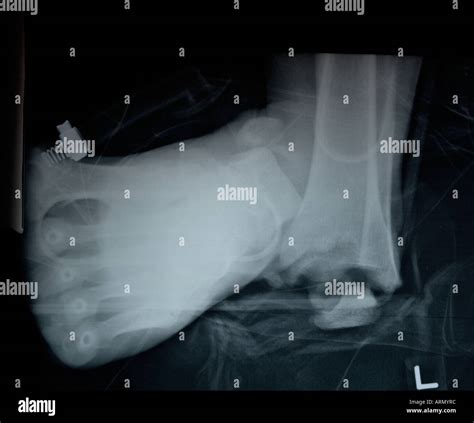 Compound Fracture Hi Res Stock Photography And Images Alamy