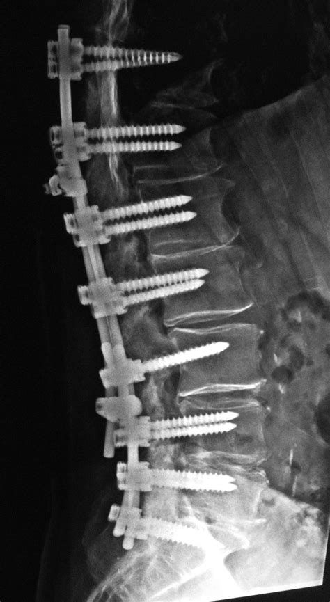 Spinal Fusion With Instrumentation And Stabilization At Rs 420000piece