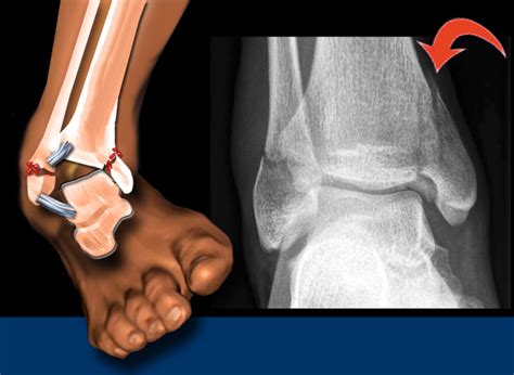 Weber Classification Ankle Fracture