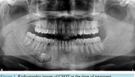 Pdf The Calcifying Epithelial Odontogenic Tumor Pindborg Tumor A