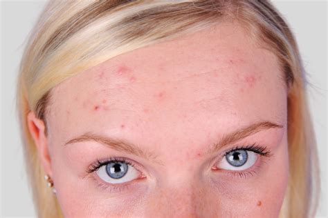 Why You Get Forehead Acne Plus How To Treat It Luminance Red
