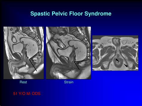 Spastic Pelvic Floor Syndrome Radiology