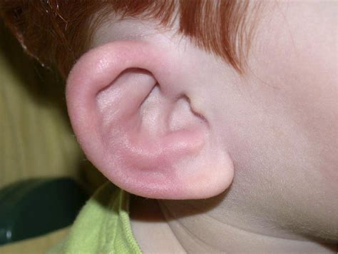A Red Ear The Journal Of Pediatrics